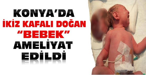 Konya'da ikiz kafalı doğan 5 günlük bebek ameliyat edildi